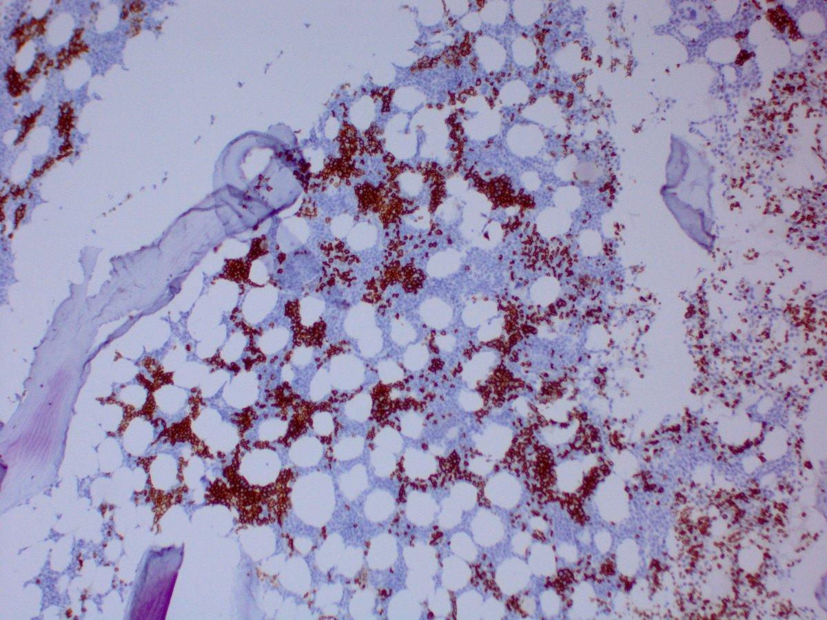 Bone marrow core biopsy IHC stain showing scattered clusters of Glycophorin A positive erythroid islands